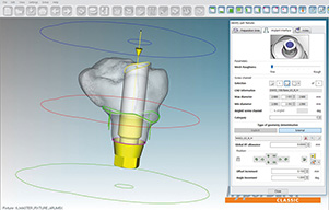 hyperdent implant module